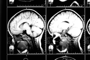 Infant Child Brain Injury MRI