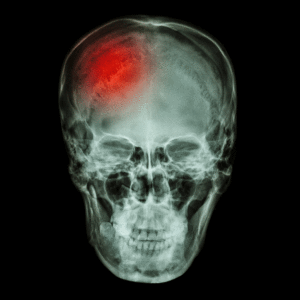 X-ray of a Skull